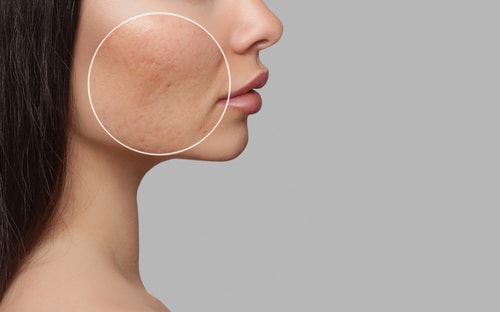 What Are The Causes Of Hyperpigmentation, And How Do We Defeat It?