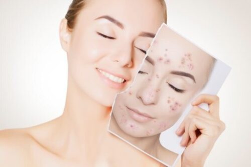 bleach Reduces blemishes