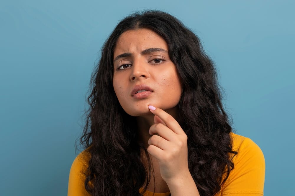 A young woman struggling with acne.