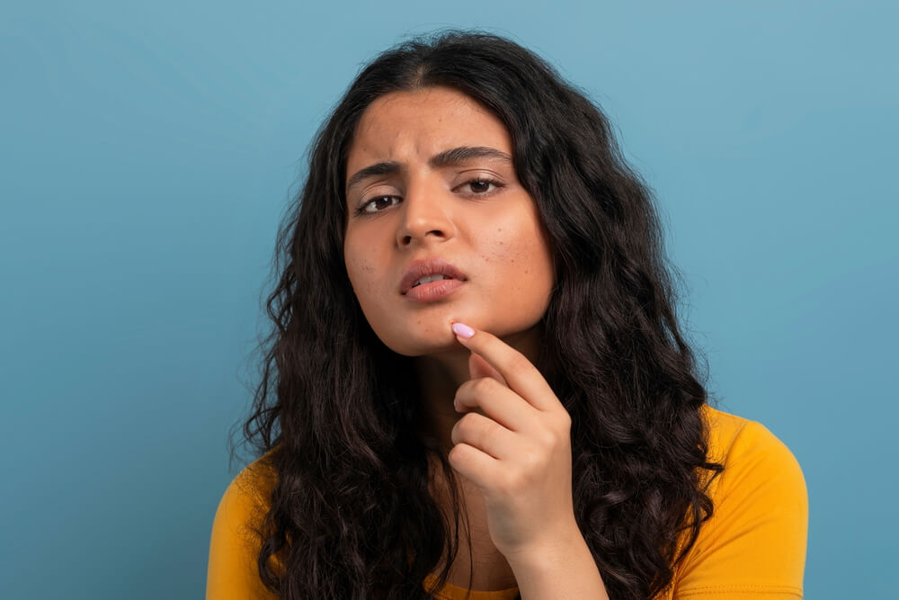 A young woman struggling with acne.