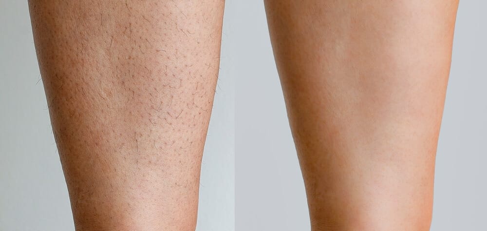 A woman who has observed significant reduction in hair growth on legs after laser hair removal treatment.