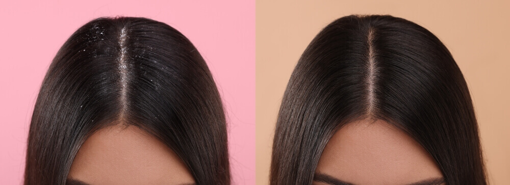 Anti-dandruff hair spa helps relieve dandruff frustration. Before and after results of anti-dandruff spa.