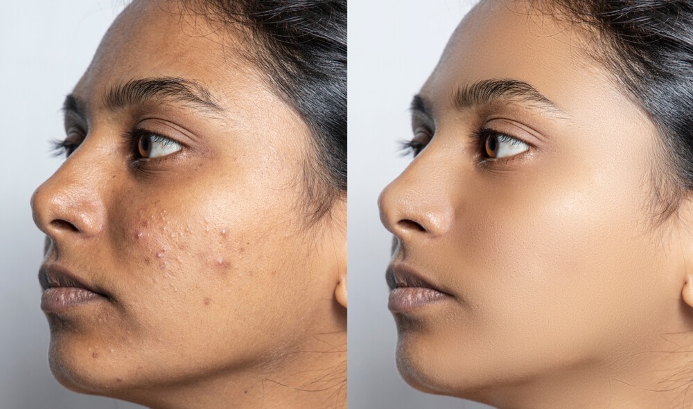 Papaya face mask helps in reducing acne and pimples.