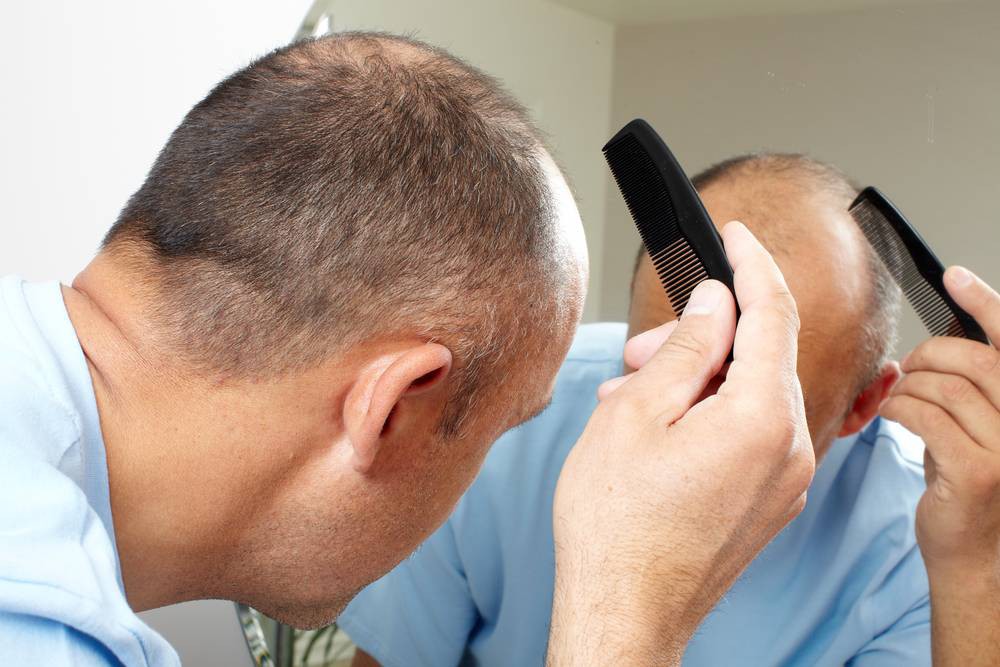 Male Pattern Baldness – Causes And Solutions