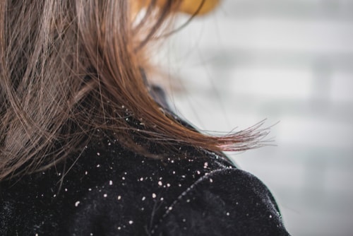 10 Home Remedies For Dandruff That Does Wonders!