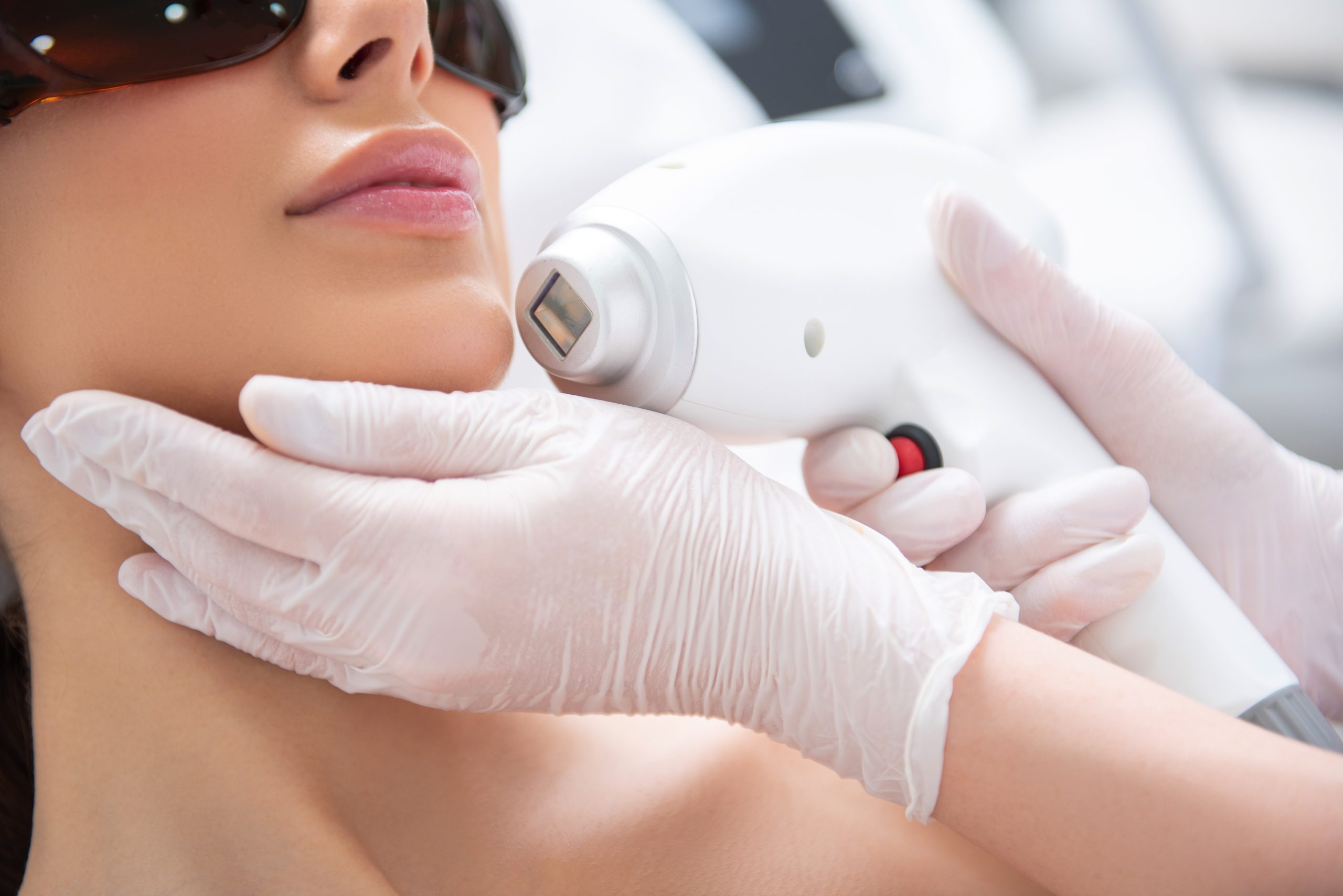 Laser Facial Hair Removal Benefits – Get Better Complexion, Reduced Acne, & More!