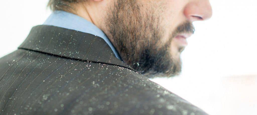 how to prevent dandruff