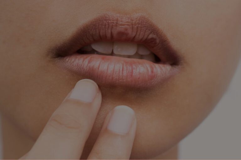 12 Best Home Remedies To Treat Chapped Lips